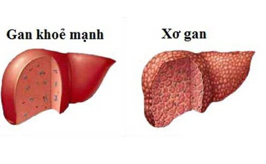 Khám Gan Như Thế Nào: Quy Trình Chi Tiết Và Những Điều Cần Biết